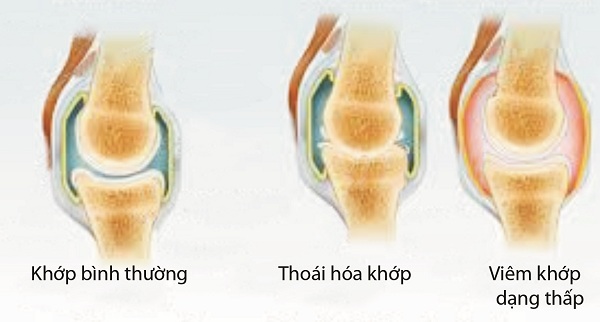 Bệnh khớp -nguyên nhân hàng đầu gây tàn phế